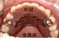 装着後1