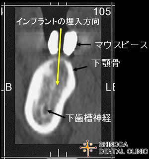 インプラント治療の診査2