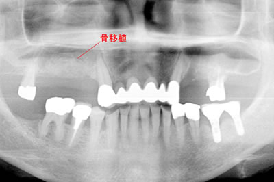 サイナスリフト(上顎洞底挙上術)2