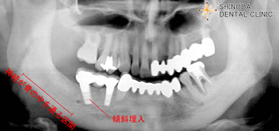傾斜埋入2