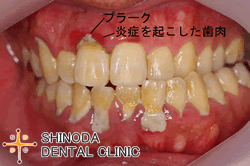 歯周病の原因はプラーク