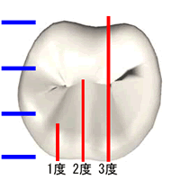 根分岐部病変