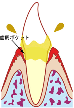 歯周ポケット1