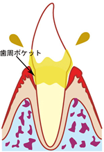 歯周病の症状 – 中等度（歯周炎）