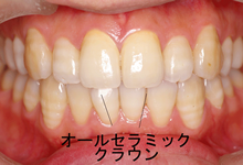 オールセラミッククラウン