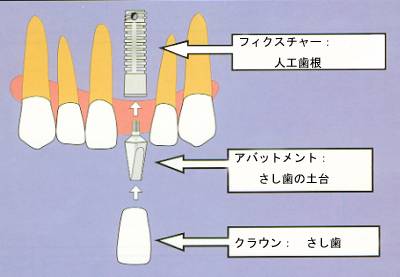 インプラント各部の名称