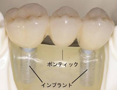 ポンティックとは?