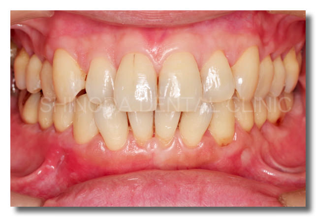 歯肉退縮　歯ぐき　さがった　後退　gingival recession ルートカバレッジ　根面被覆　root coverage VISTA 中野区東中野　歯周病専門医　篠田歯科